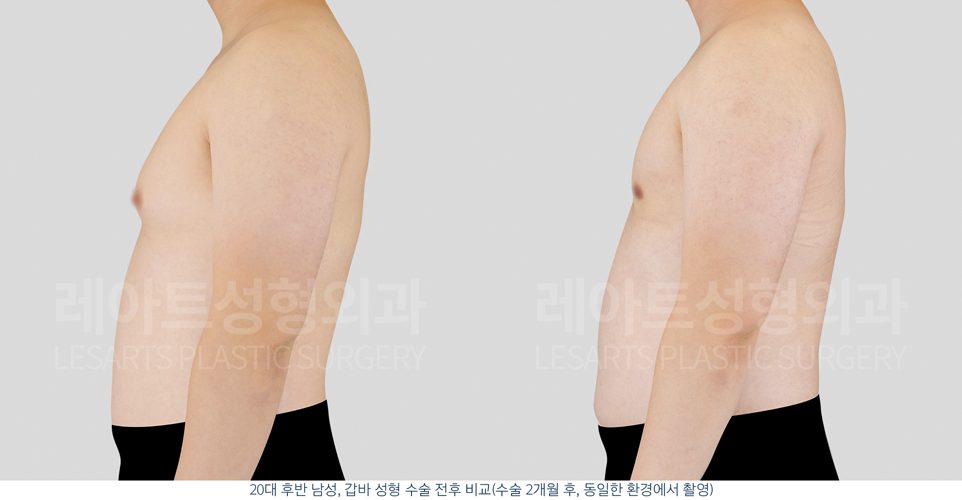 여유증 수술 옆모습 전후사진 그레이드 2-A