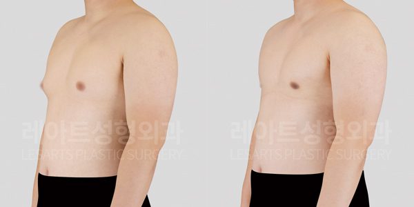 레아트 성형외과 여유증 수술 전후사진 그레이드 2-A