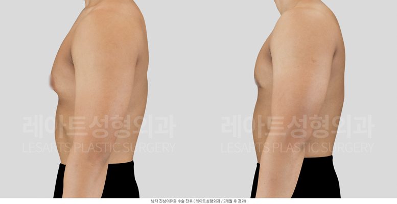 여유증 수술 후 옆모습 전후사진- 레아트 성형외과
