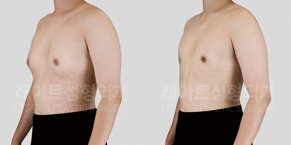 10대 여유증 수술 전후사진 - 레아트 성형외과
