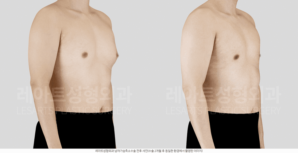 여유증 수술전후사진-레아트성형외과