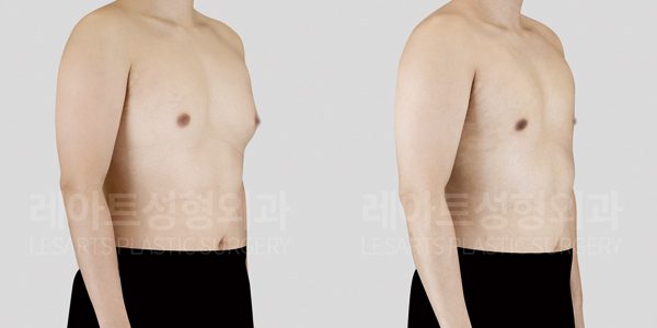 여유증 수술 전후사진