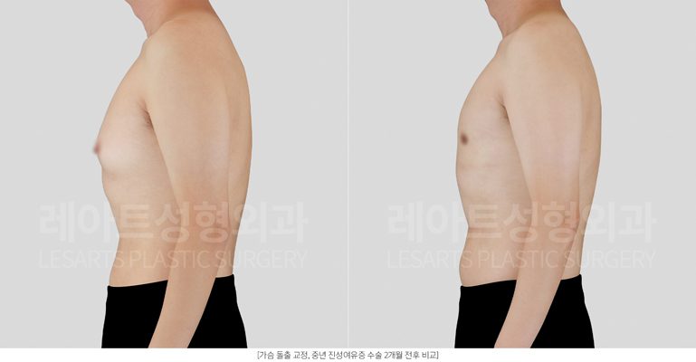 여유증 수술 전후 - 레아트 성형외과