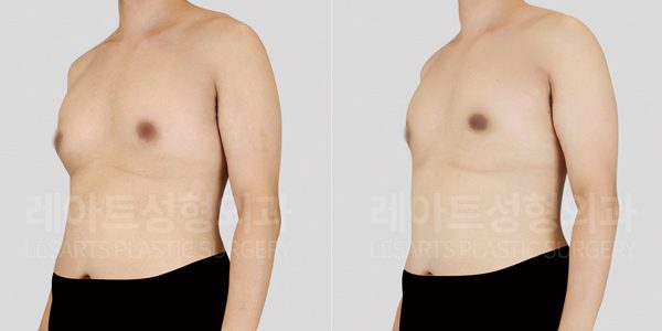 입대전 여유증 수술 전후사진