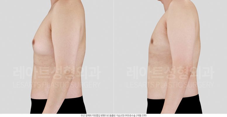여성형유방증 수술 후 전후사진