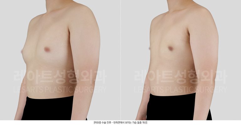 청소년 여유증수술 전후사진 - 레아트 성형외과