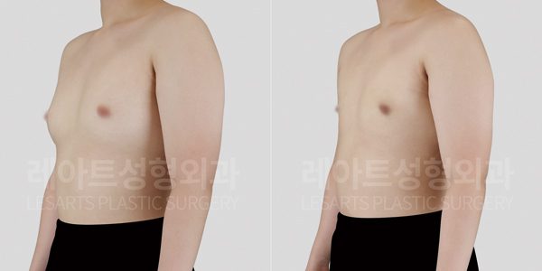청소년 여유증 수술 전후사진