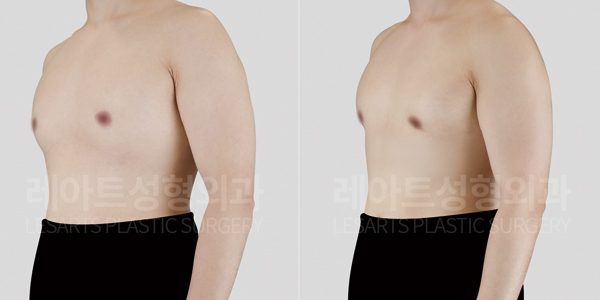 여유증 수술 전후사진 - 레아트 성형외과