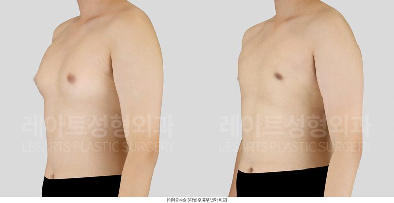 여유증 수술 전후사진
