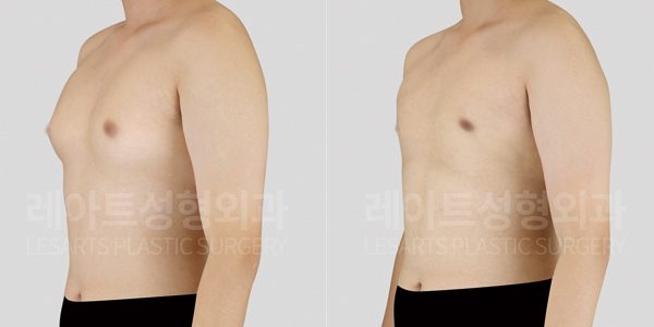 청소년 여유증 수술 전후사진 - 레아트 성형외과