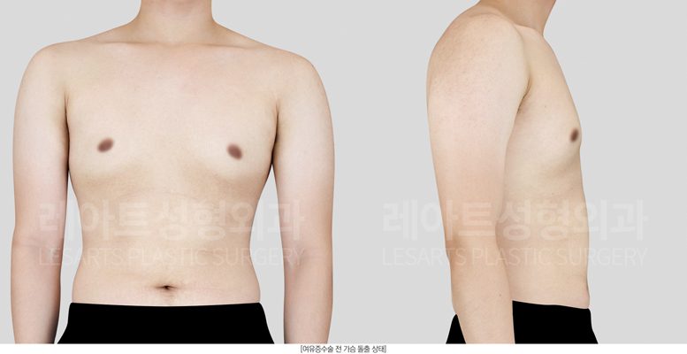 그레이드1 여유증 수술 전후사진