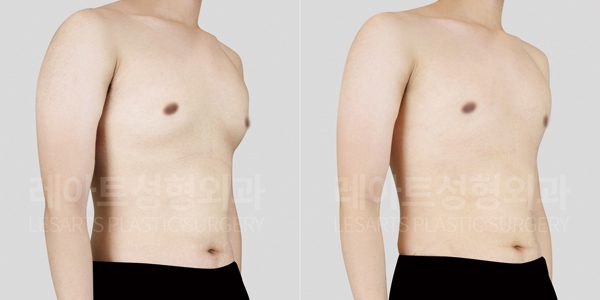 그레이드1 여유증 수술 전후사진