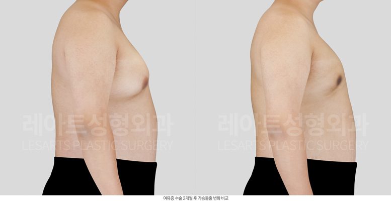 여유증 수술 후 옆모습