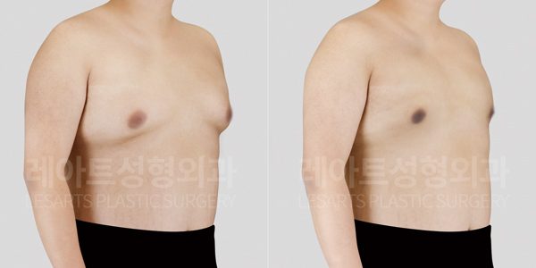 여유증 수술 후 전후사진 레아트 성형외과