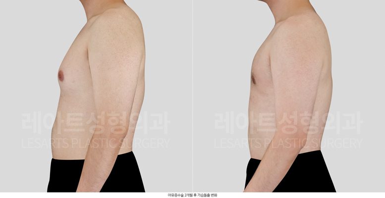 여유증 수술 전후사진