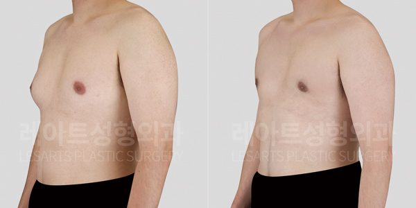 청소년 여유증 수술전후사진 레아트 성형외과