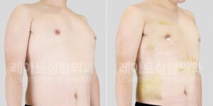 여유증 전후 사진 그레이드 2-a