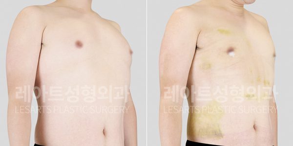 여유증 전후 사진 그레이드 2-a