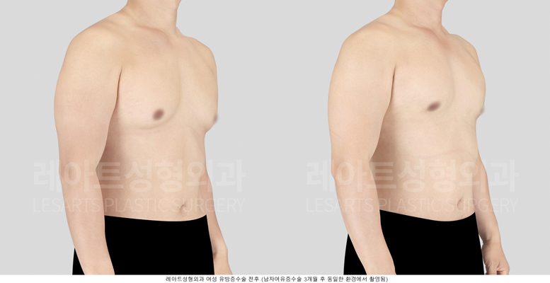 여유증 수술 전후 레아트 성형외과