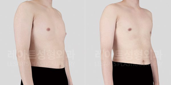 여유증 수술 전후 사이먼그레이드 2-A