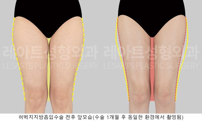 허벅지 지방흡입 허틈만드리기