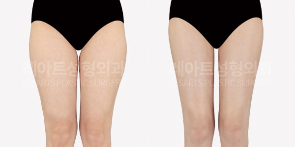 허벅지 지방흡입 전후사진 - 레아트 성형외과