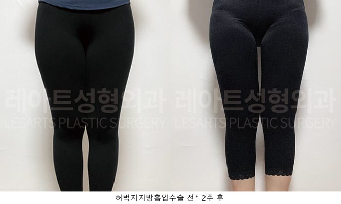 허벅지 지방흡입 전후 셀카사진