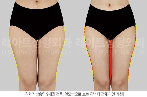 허틈 지방흡입 전후사진 - 레아트 성형외과