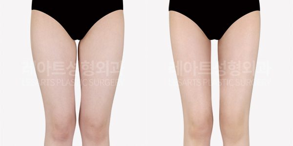 허벅지 지방흡입 전후사진