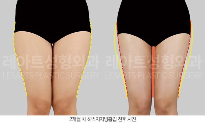 허벅지 지방흡입 수술 후 - 레아트 성형외과