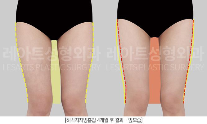 허벅지 지방흡입 전후사진 레아트 성형외과