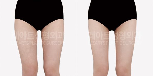 허벅지 지방흡입 레아트 성형외과