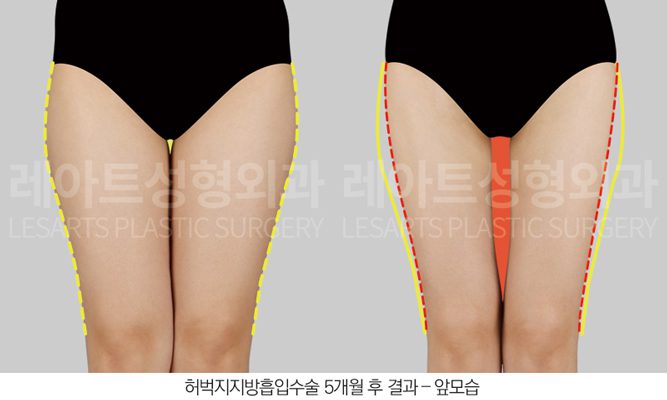 허벅지 지방흡입으로 허틈 만들기