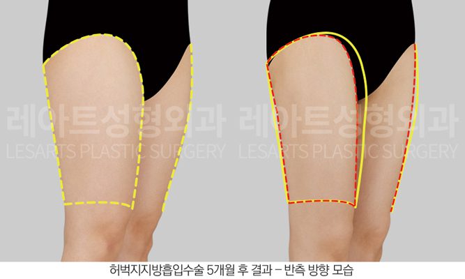 허벅지 승마살 지방흡입 전후사진