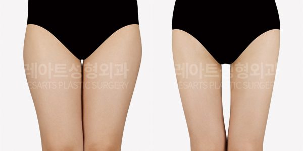 허벅지 지방흡입 전후사진