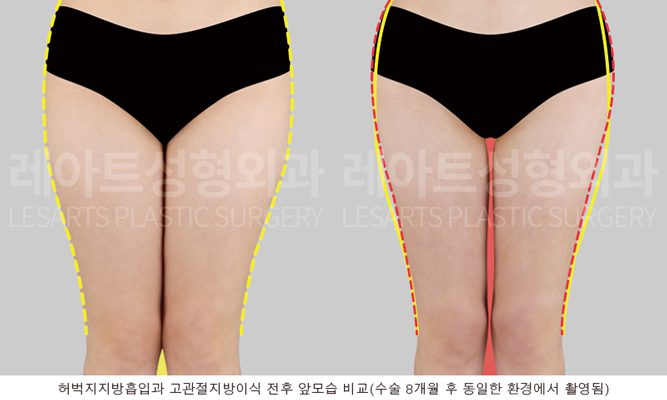 고관절 지방이식 전후 사진 - 레아트 성형외과