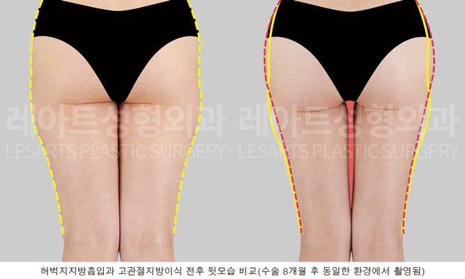 고관절 지방이식으로 힙딥 개선 전후사진