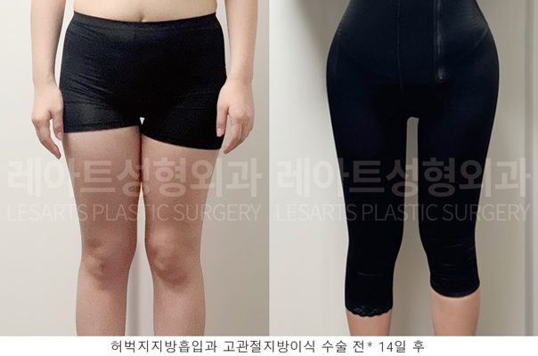 허벅지 지방흡입 전후사진