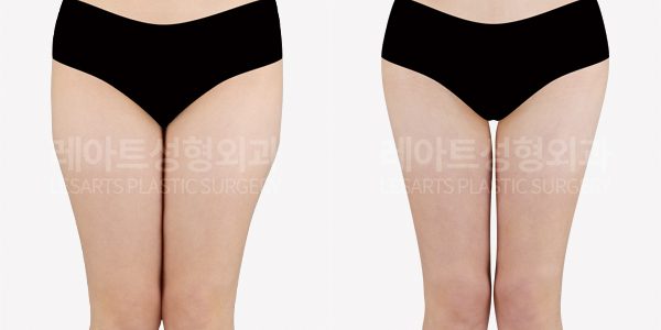 고관절 지방이식 전후 사진