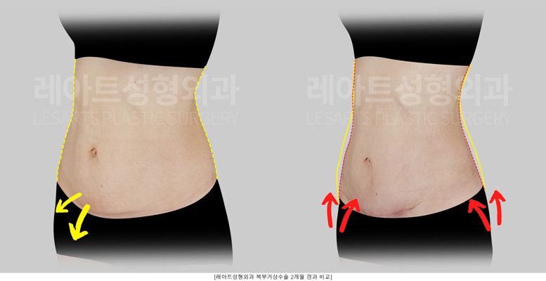 출산후 복부거상 전후사진