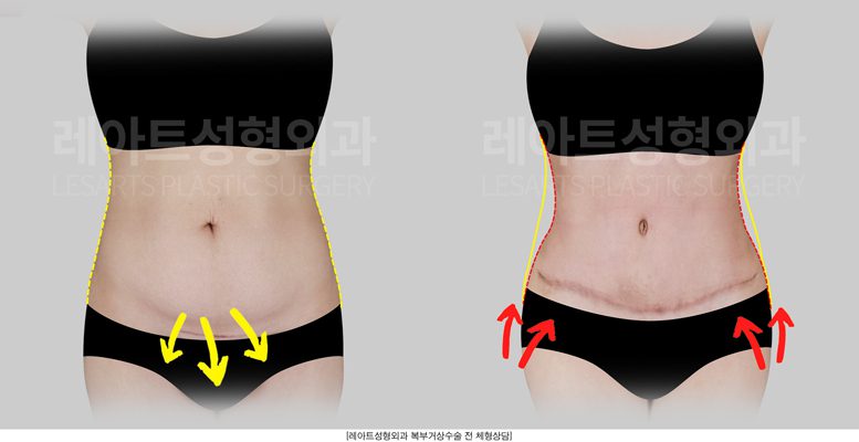 복부거상 전후사진 - 레아트 성형외과