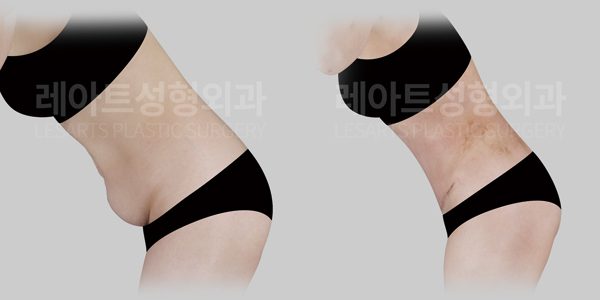 출산 후 복부거상 수술 전후