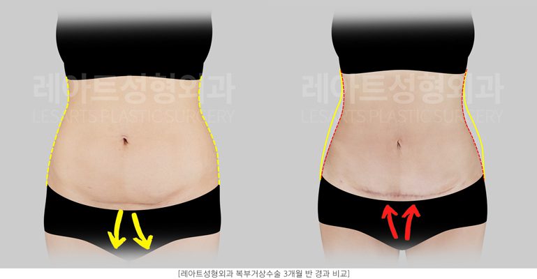 복부거상 전후 앞모습