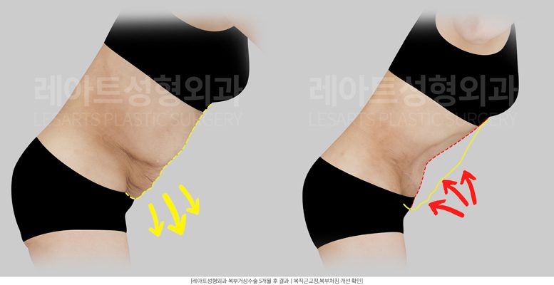복부거상 처짐 교정 - 레아트 성형외과