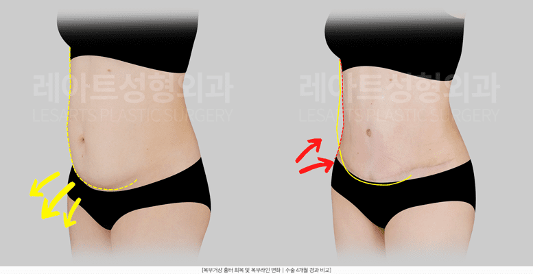 복부거상 처진 뱃살 교정 사례