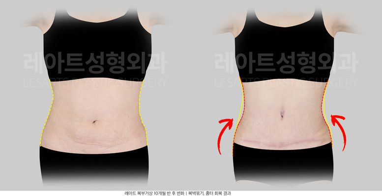 복부거상술 전후사진