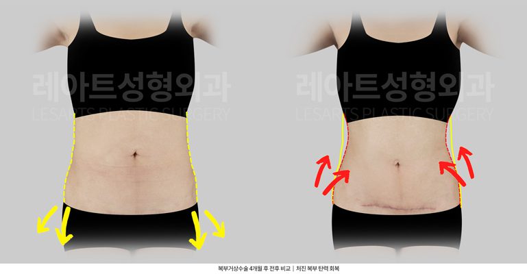 미니 복부거상수술 전후사진- 레아트 성형외과