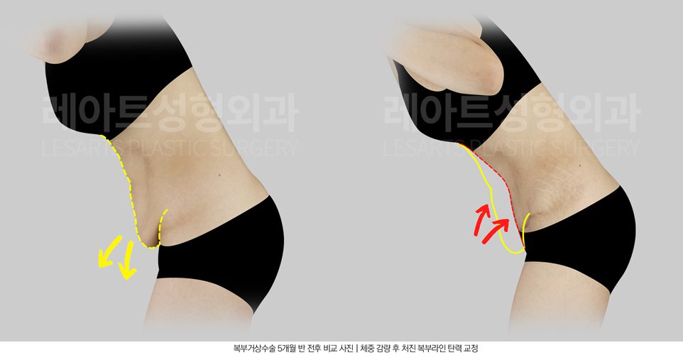 고도비만 복부거상수술 전후사진