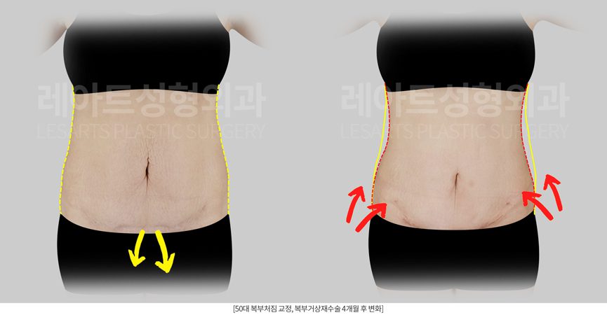 복부거상수술 전후사진