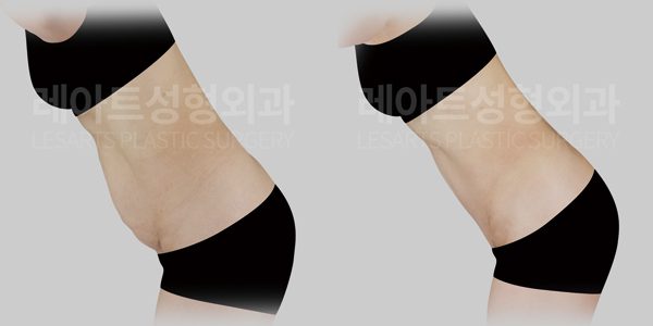 복부거상 전후사진 레아트 성형외과